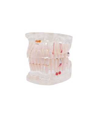Modelo Transparente Bader con implante