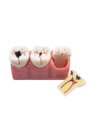Modelo Desmontable Caries Bader