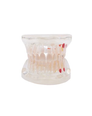 Modelo transparente de caries Bader