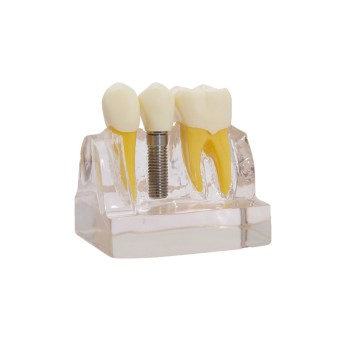 Modelo demostración de implantes Bader