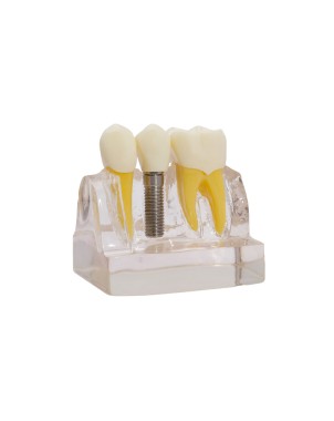 Modelo demostración de implantes Bader
