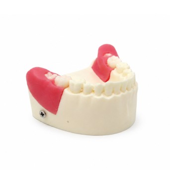 Modelo de Extracción de Dientes Retenido y Semiretenido Bader