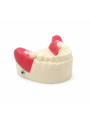 Modelo de Extracción de Dientes Retenido y Semiretenido Bader